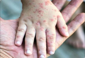 شناسایی ابتلا به سرخک در البرز